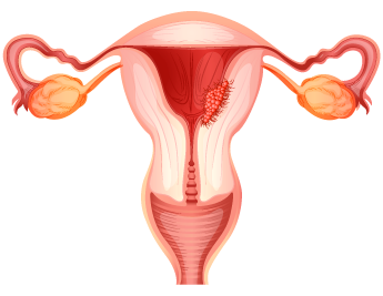 Cáncer de endometrio (útero o matriz)
